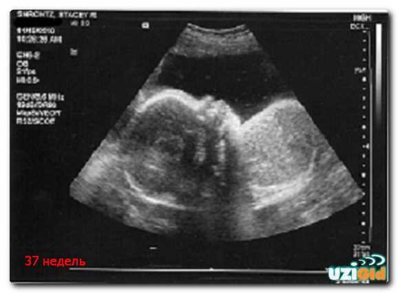 Сравнение плодов при многоплодной беременности